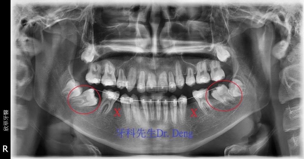 拔除下颚两侧第二小臼齿后把第一与第二大臼齿往前提供倾斜大臼齿转正